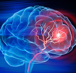 Illustration of a stroke in a brain