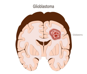 Glioblastoma