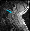 arthritic-breakdown-in-upper-cervical-spine-scan