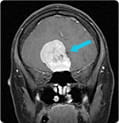 olfactory-groove-meningioma-scan