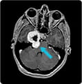 trigeminal-schwannoma-scan