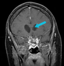post-surgical scan of successful removal of large tumor via endoscopic endonasal approach surgery