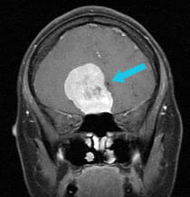 pre-surgical scan of large olfactory groove meningioma