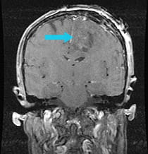 Post-surgical scan shows the successful removal of tumor.