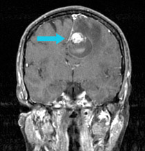 Pre-surgical scan shows metastasis on the frontal lobe.