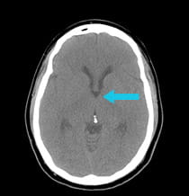 post-surgery scan showing completely removed colloid cyst