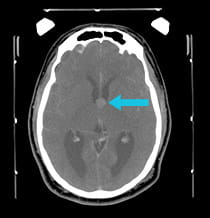 pre-surgical scan shows a colloid cyst of the third ventricle