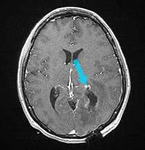 Post-surgical scan displays successful removal of glioblastoma.