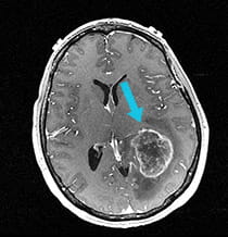 Presurgical scan of 4 cm glioblastoma