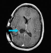 Post-surgical scan showing removal of intraventricular meningioma.