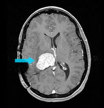 Pre-surgical scan showing 6m meningioma in the ventricle.