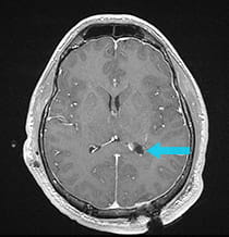 Post-surgical scan shows the ventricle is visible on the scan as a dark space. 