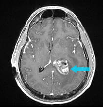Pre-surgical scan shows a intraventricular tumor.