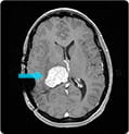 Recurrent Intraventricular Meningioma X Ray