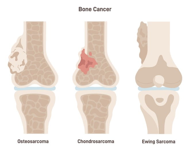 Image of Osteosarcoma, Chondrosarcoma and Ewing Sarcoma.
