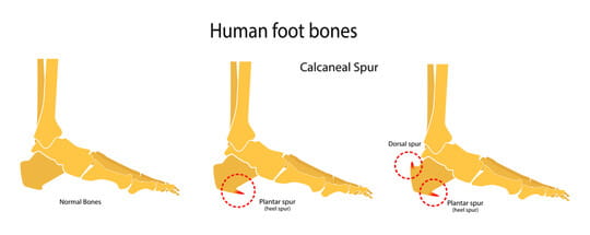 Human foot bones with calcaneal spur.