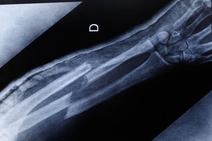 X-ray of  broken arm bones.