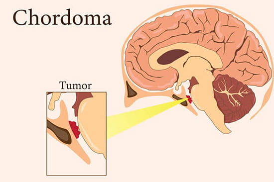 Photo of a Chordoma.