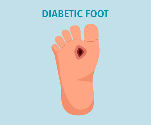 Diabetic foot.
