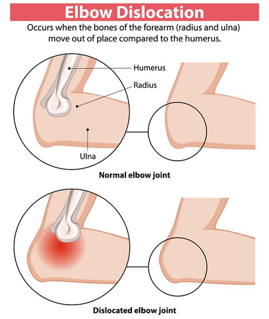 Image of a dislocated elbow.