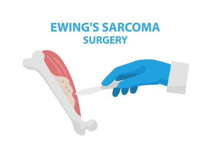 Image of Ewing's Sarcoma Surgery.