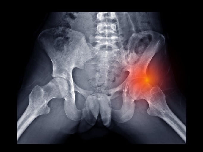 Image of hip x-ray with Femoroacetabular Impingement.