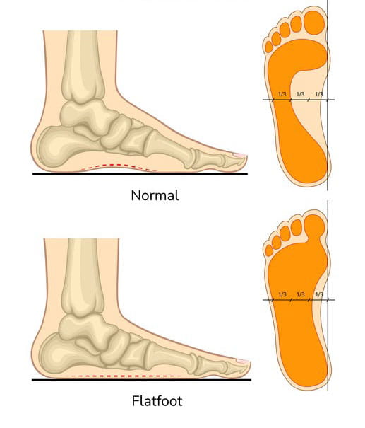 Image of a flatfoot versus a normal foot.