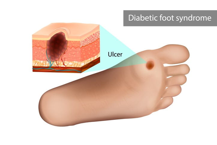 Image of a foot ulcer.