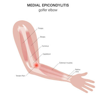 Medial Epicondylitis (golfers elbow).