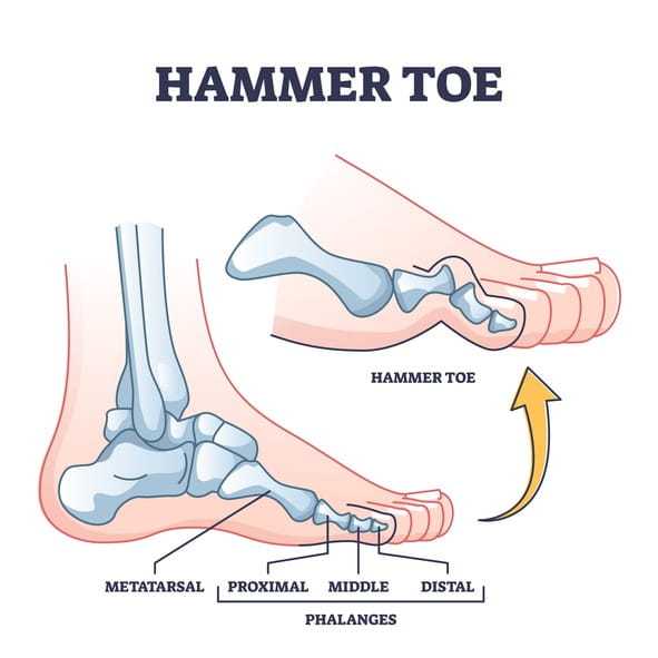 Image of a hammer toe.