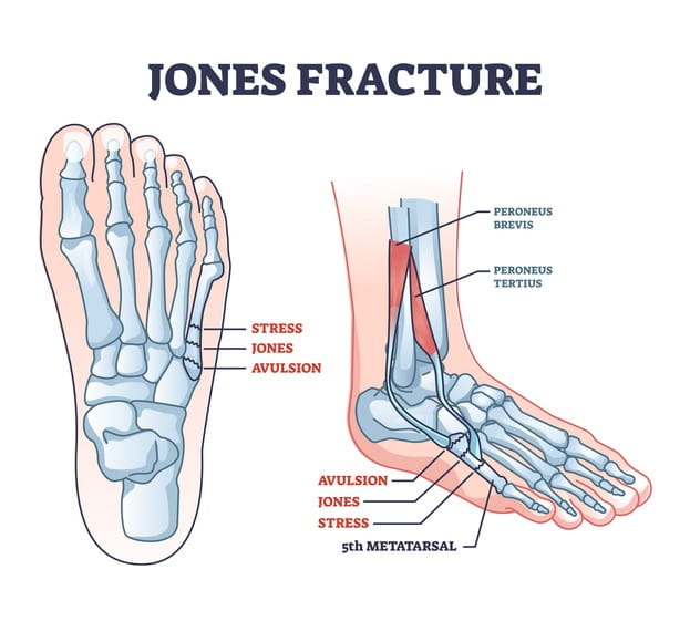 Image of a Jones fracture.