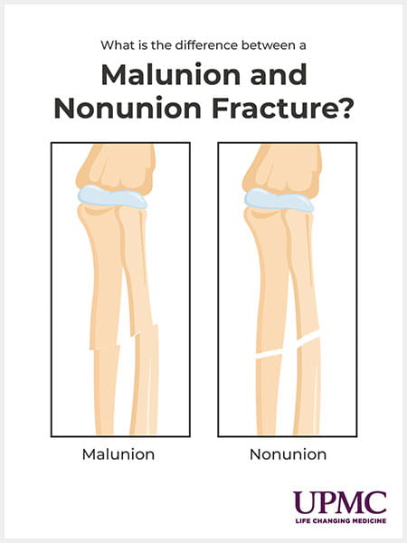 What is the difference between a malunion and nonunion fracture?