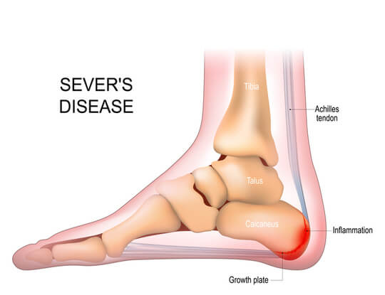 Sever's disease.