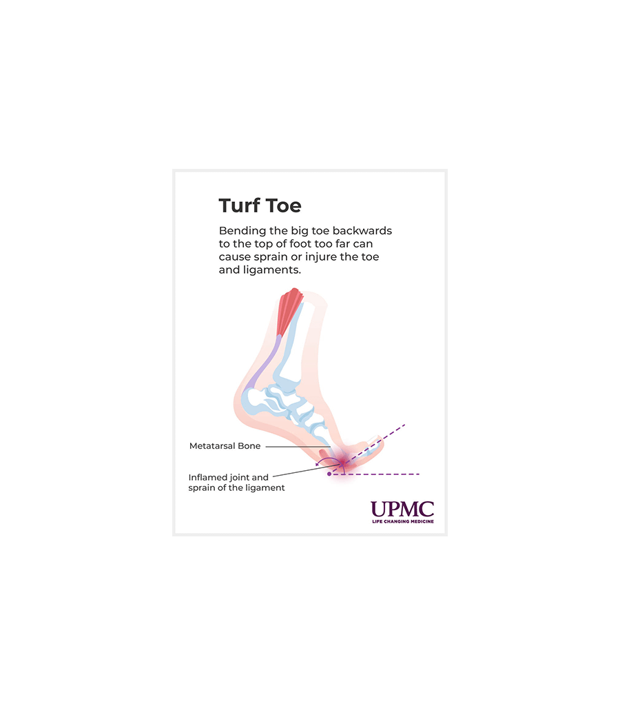 Turf Toe Symptoms, Diagnosis, and Treatment | UPMC