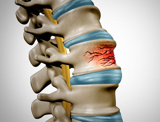 Image of a traumatic spine fracture.
