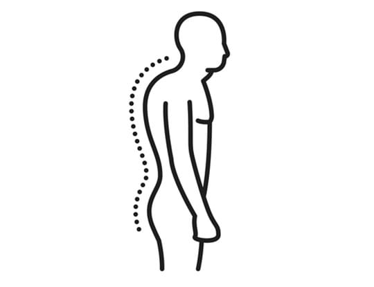 Image of man with abnormal back posture associted with kyphosis.
