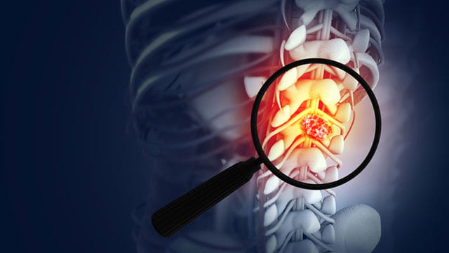 Magnifying glass showing the spine cancer or spinal tumor disease.