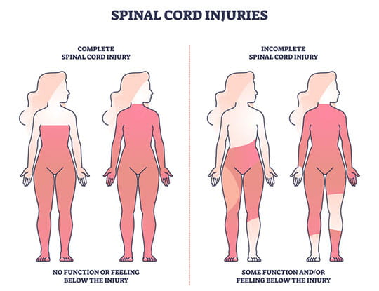 Spinal cord injuries with complete or incomplete trauma outline diagram.