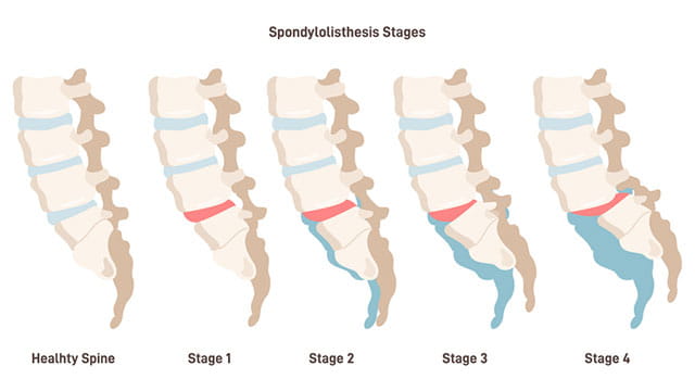 Images of Spondylolisthesis. Spinal disease when lower vertebrae slip forward and the stages of severity.