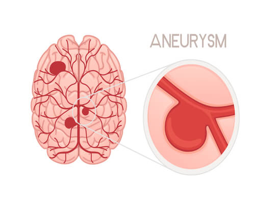 Human brain with blocking stroke in brain or aneurysm disease