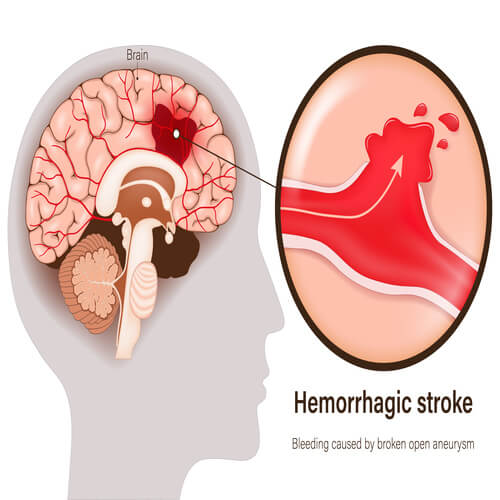Image of aHemorrhagic stroke in the brain with bleeding caused by broken open aneurysm. 