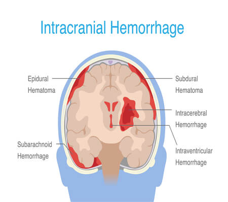 Image of the 4 types of intracranial hemorrhage including Epidural hemorrhage, Subdural , Subarachnoid, and Intraparenchymal and where they occur in the brain