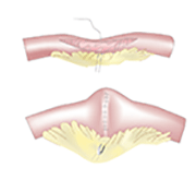 Strictureplasty