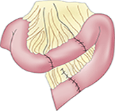 Reversed intestinal segment