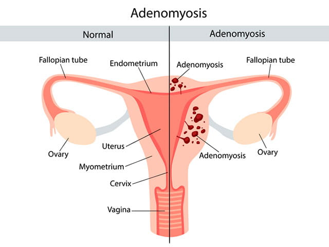 Anatomical illustration of the normal female reproductive system and with the symptoms of adenomyosis, with annotations. 