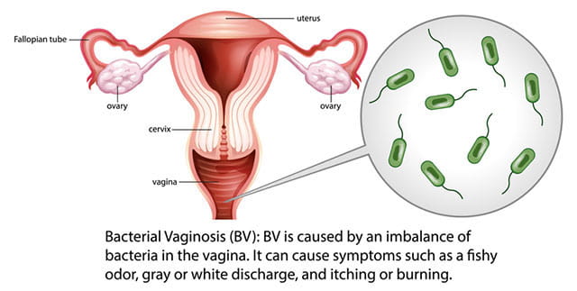 Bacterial Vaginosis (BV) infographic with explanation.