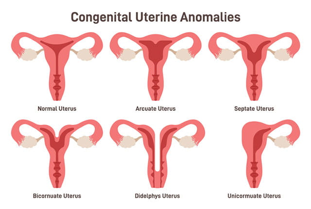 Images of the types of congenital uterine anomalies.