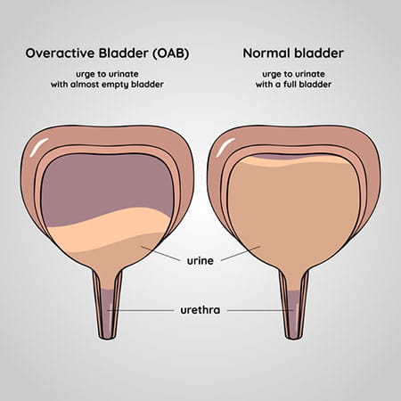 Image of an overactive and normal bladder.