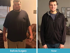 Jake Smith Before and After Surgery Image