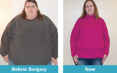 Gastric Bypass Story | Melissa Silvis